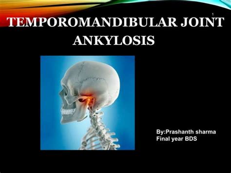 Tmj ankylosis-oral and maxillofacial surgery