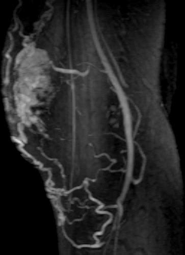 MR Imaging of Soft-Tissue Vascular Malformations: Diagnosis, Classification, and Therapy Follow ...