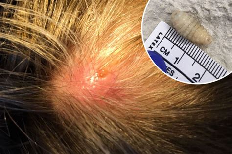 Woman with wriggly, itchy lumps on her scalp discovers they're BOTFLY ...