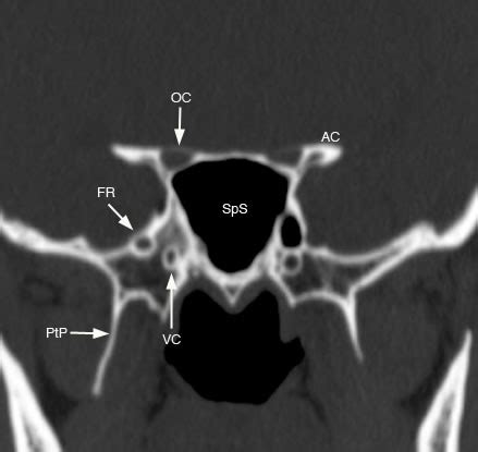 Sphenoid Sinus: Normal Anatomy & Variants