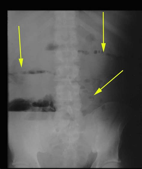 Small Bowel Obstruction on X-ray - X Rays Case Studies - CTisus CT Scanning