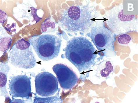 Pleural Effusion Cytology