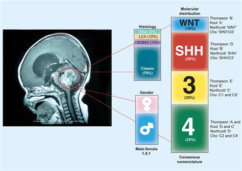 Medulloblastoma Cancer - Causes, Symptoms, Prognosis & Treatment