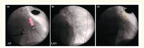 CardioMEMS sensor implantation. (A, B) In the first phase of the ...