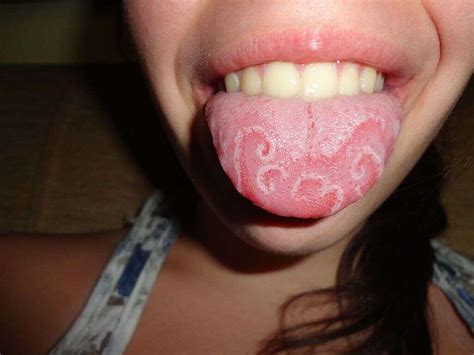 Sore Tongue: 10 Causes of a Sore Tongue