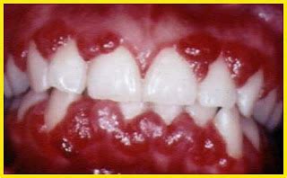 Dentistry lectures for MFDS/MJDF/NBDE/ORE: Images and Description Of Some Gingival And ...
