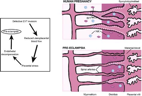 The pathophysiology of Pre-Eclampsia. | Download Scientific Diagram