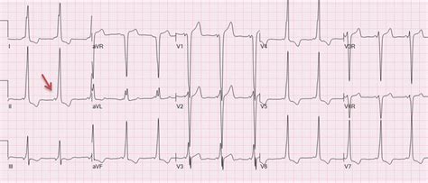 Wolff–Parkinson–White pattern with short PR interval and delta wave (arrow) | Download ...