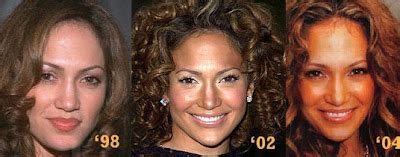 Jennifer Lopez Plastic Surgery Before and After Botox Injections ...