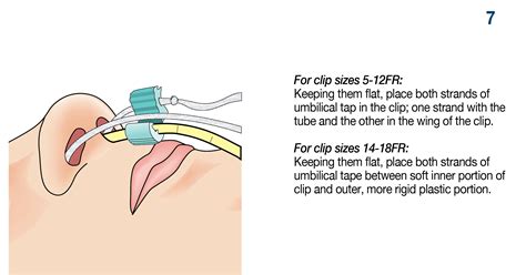 AMT Bridle™ Family | Nasal Tube Retaining Systems, Nasal Bridle