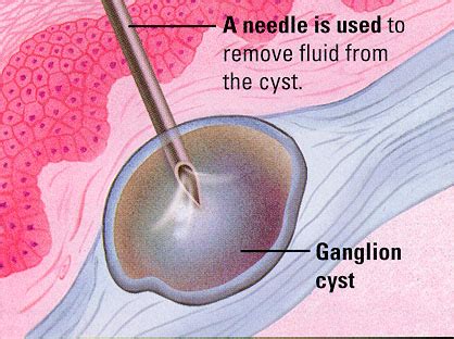 Treatment for Ganglion Cyst | 🏥Singapore Orthopaedic & Sports Medicine