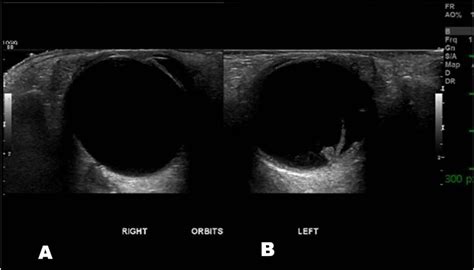 Retinal Detachment