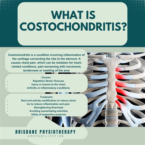 What is Costochondritis? - Brisbane Physiotherapy