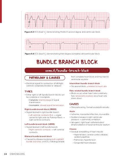 right bundle branch block - Milk Peak