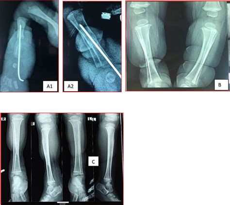 A1: This X-ray of the leg shows a fracture of the leg treated with ...