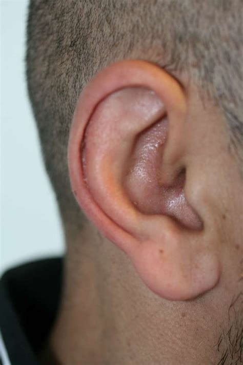 Ear and ear lobe reduction for macrotia (big ears / ear lobes)