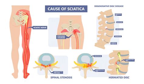 More Than Half of Americans Plagued by Back, Leg Pain - Comprehensive Orthopaedics