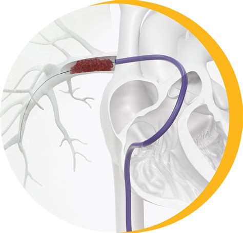 FlowTriever® system for the treatment of pulmonary embolism (PE ...