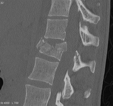 Thoracolumbar Burst Fracture | Bone and Spine