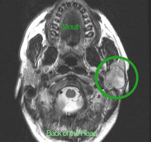 Parotid Gland Tumor Ultrasound