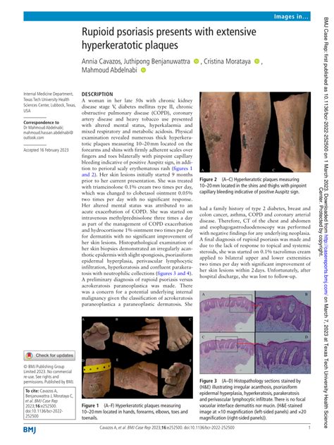 (PDF) Rupioid psoriasis presents with extensive hyperkeratotic plaques