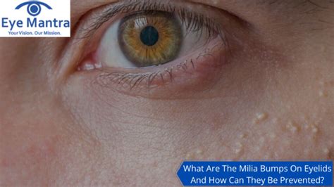 Milia Bumps on Eyelids | Home Remedies For Eyelid Bumps