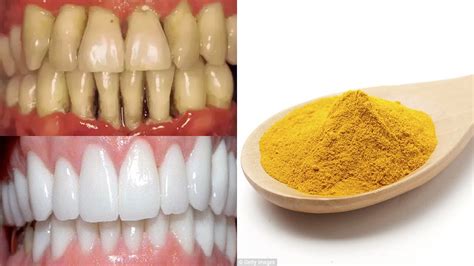 How to whiten teeth naturally with turmeric in 2 Minutes | Magical ...