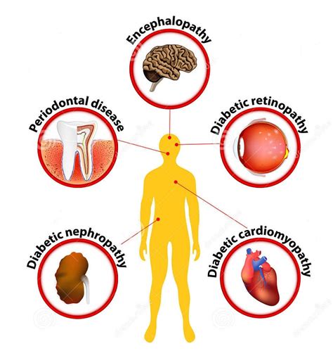 Diabetes - related complications and consequences | Health Care "Qsota ...