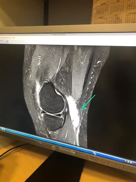 My ruptured Baker’s Cyst : r/medizzy