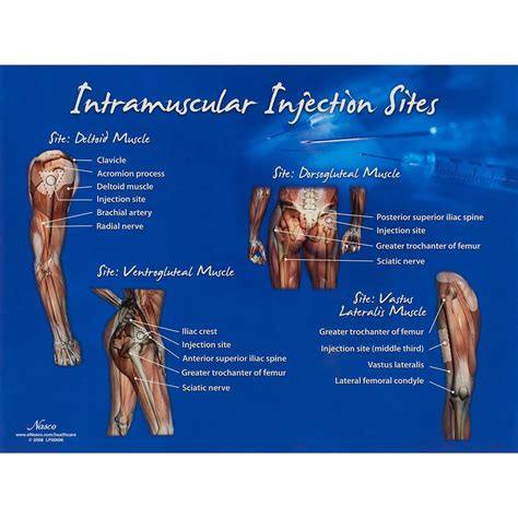 Im Injection Sites Chart