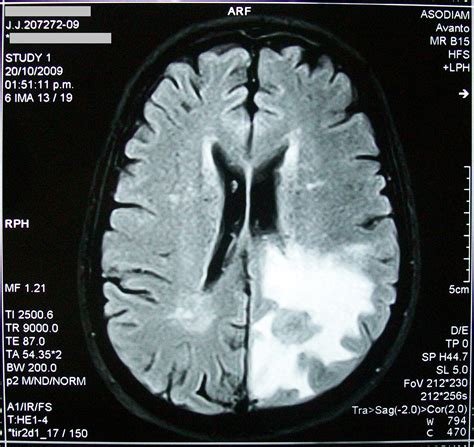 Brain Tumor Pictures Mri