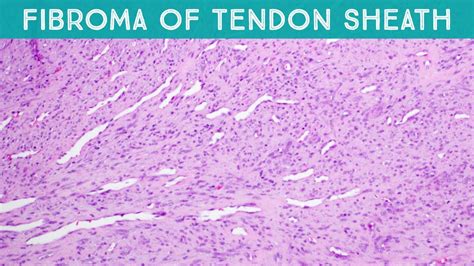 Giant Cell Fibroma Histology