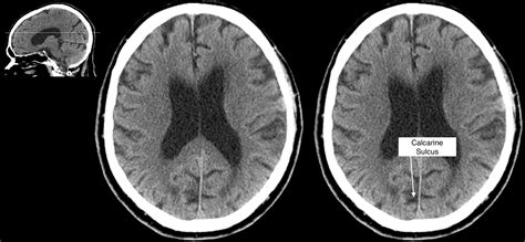 Radiological Anatomy: Calcarine Sulcus - Stepwards