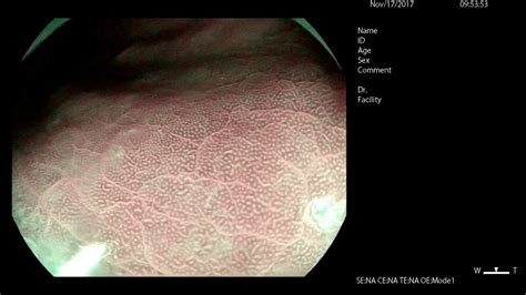 H. pylori Diagnosis with Magnifying Endoscopy - YouTube