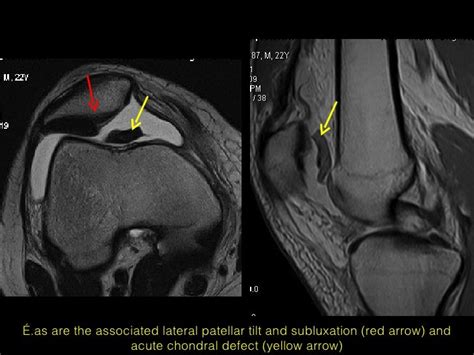 MRI of patellar disorders