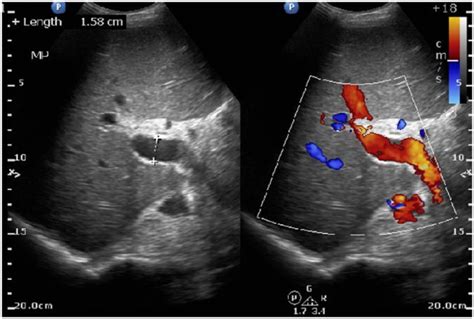 Portal Hypertension Ultrasound