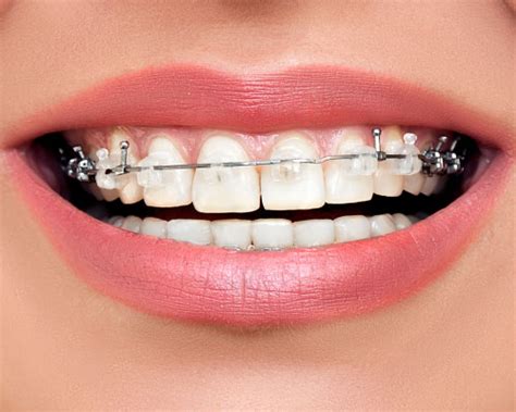 Clear Braces for Adults in Kissimmee, FL | Kendrick Orthodontics