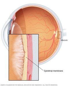 Causes of Epiretinal Membrane | Southern Vitreoretinal Associates