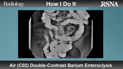 Air (C02) Double-Contrast Barium Enteroclysis (How I Do It) - YouTube