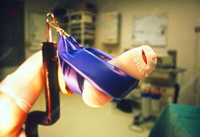 Hysterectomy surgery - Stock Image - M852/0064 - Science Photo Library