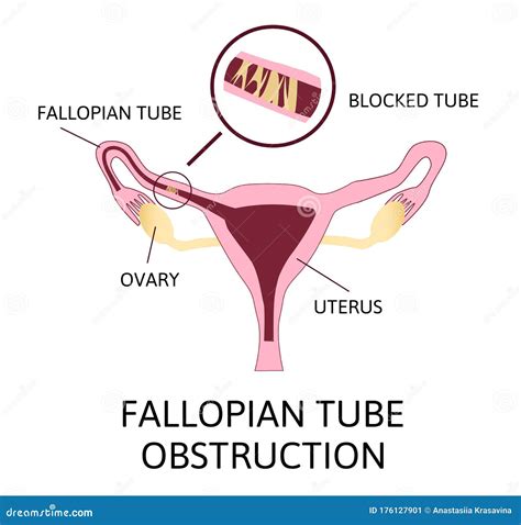 Fallopian Tube Obstruction or Blocked Fallopian Tubes Stock Vector - Illustration of ...