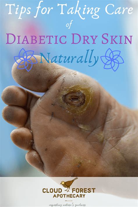 Blood Sugar Guide Complete: how to heal diabetic leg ulcers naturally