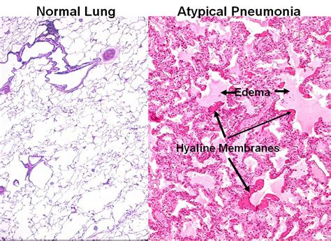 Pneumonia Histology