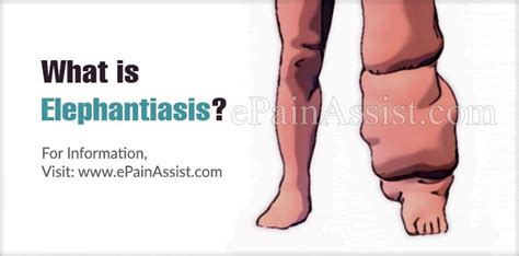 Elephantiasis|Causes|Symptoms|Treatment|Diagnosis