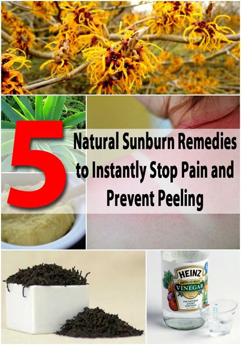 5 Natural Sunburn Remedies to Instantly Stop Pain and Prevent Peeling - DIY & Crafts