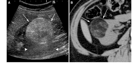 Angiomyolipoma, classic type, in a 61-year-old woman. Ultrasound (A ...