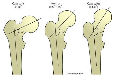 Coxa vara - wikidoc