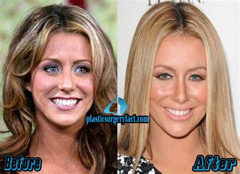 Aubrey O’Day Plastic Surgery Before and After Photos