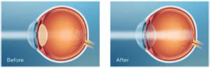 PanOptix Trifocal Lenses (IOL) for Cataract Surgery & RLE