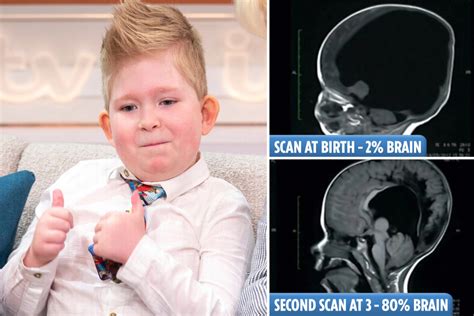 Noah Wall - Boy Born Without A Brain | Brain Miracle Child - Amazing ...